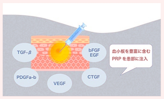PRP療法
