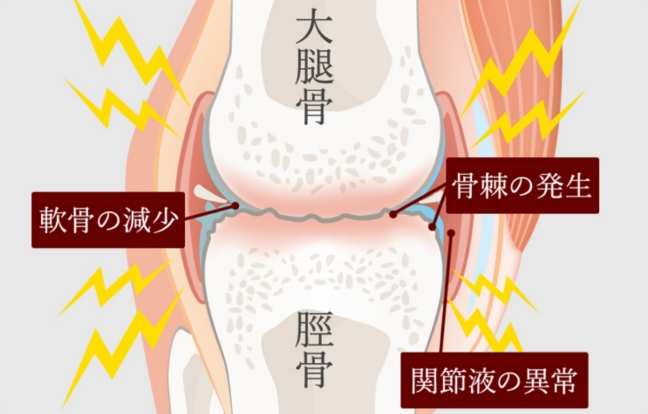 変形性膝関節症